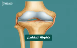 صورة طبية توضيحية لخشونة المفاصل في الركبة وتآكل الغضاريف