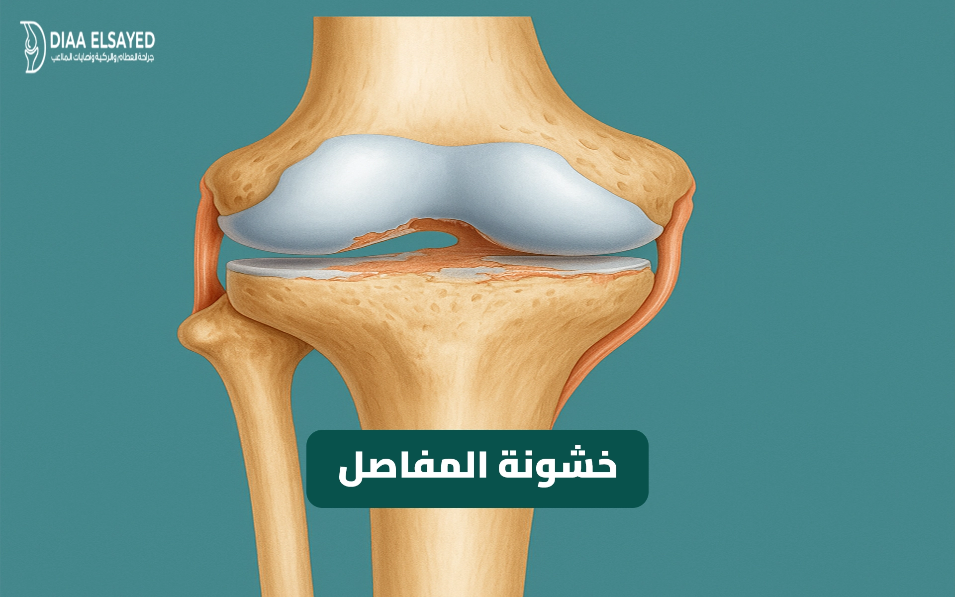 صورة طبية توضيحية لخشونة المفاصل في الركبة وتآكل الغضاريف