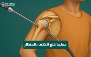 صورة توضيحية لعملية خلع الكتف بالمنظار باستخدام تقنيات جراحة العظام الحديثة