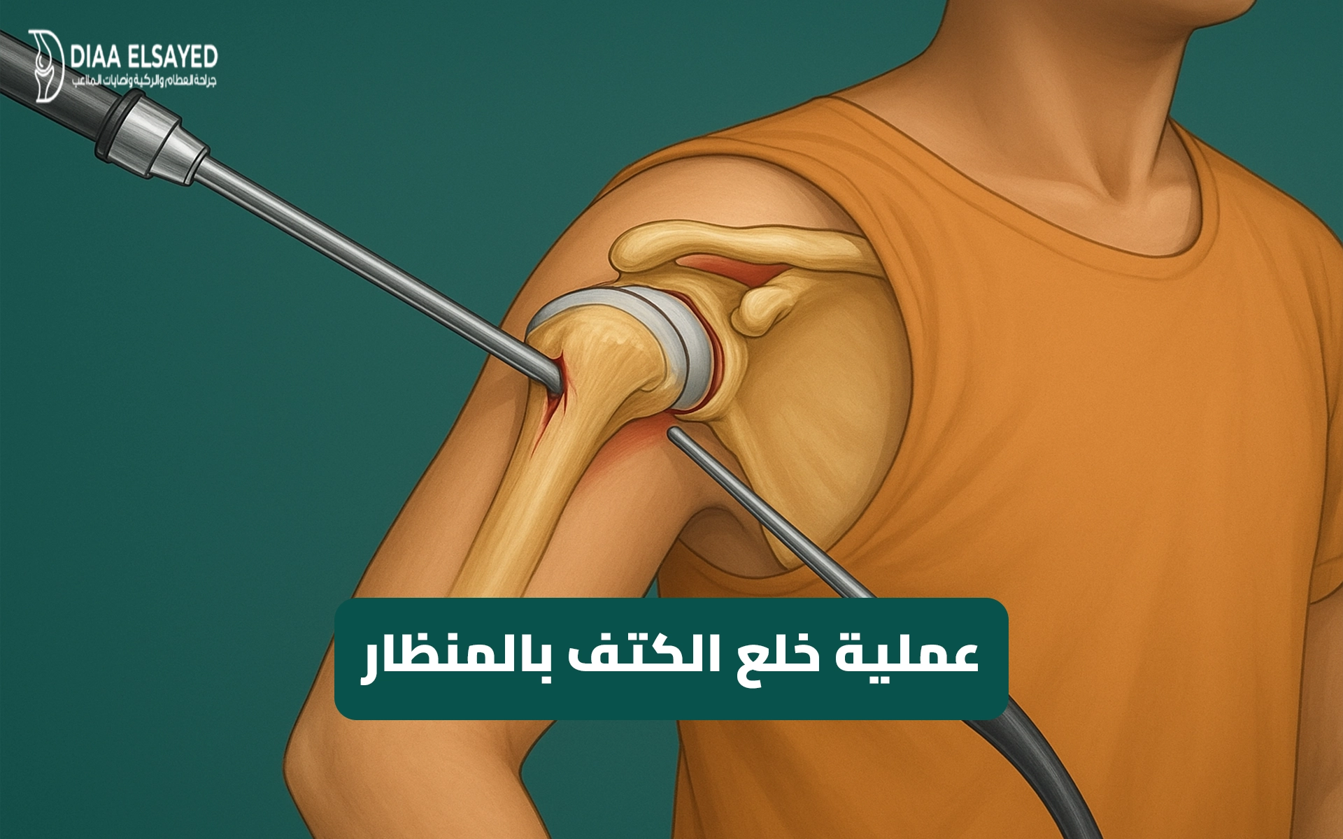 صورة توضيحية لعملية خلع الكتف بالمنظار باستخدام تقنيات جراحة العظام الحديثة